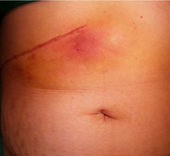 Laparoscopic chole scars 